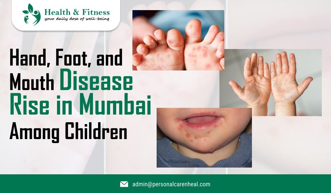 Hand, Foot, and Mouth Disease Rise in Mumbai Among Children