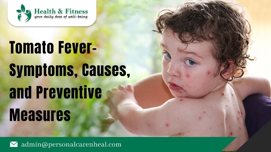 Tomato Fever- Symptoms, Causes, And Preventive Measures