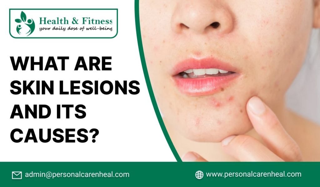 What are Skin Lesions and its Causes?
