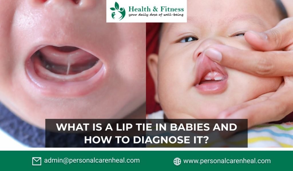 Lip Tie in Babies