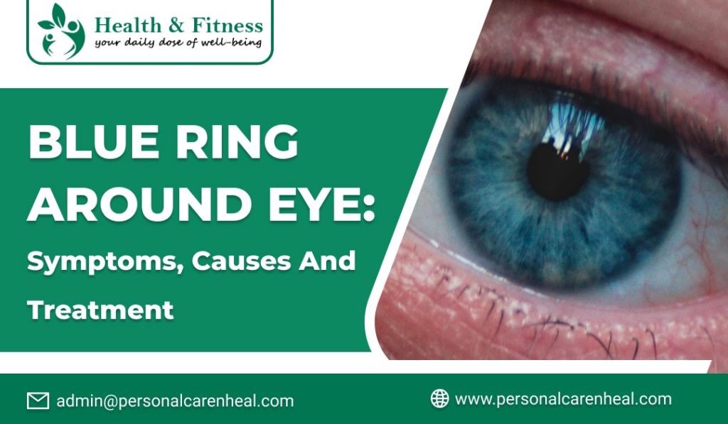 Blue Ring Around Eye Causes, Symptoms and Treatment