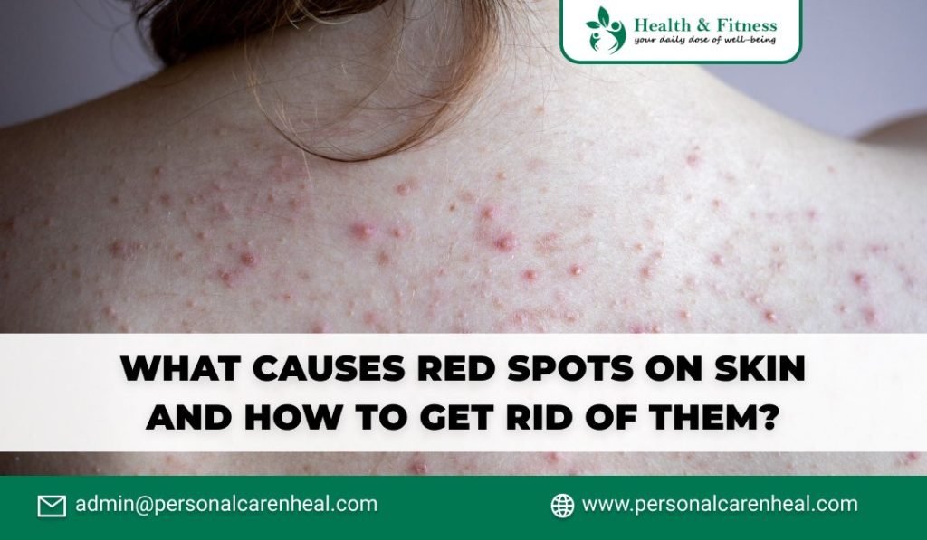 What Causes Red Spots on Skin and How to Get Rid of Them