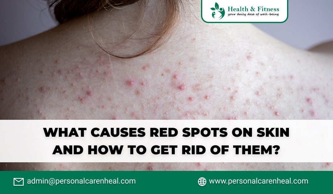 What Causes Red Spots On Skin And How To Get Rid Of Them