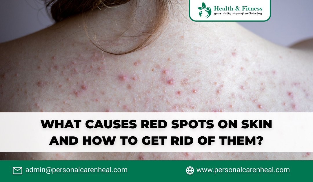 What Causes Red Spots on Skin and How to Get Rid of Them?