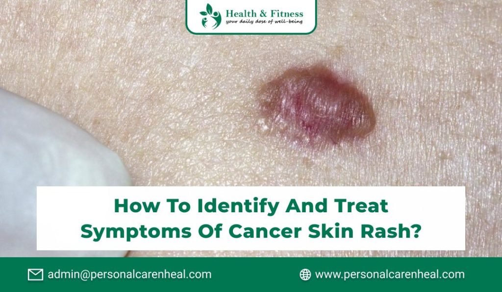 How to identify and treat symptoms of cancer skin rash 