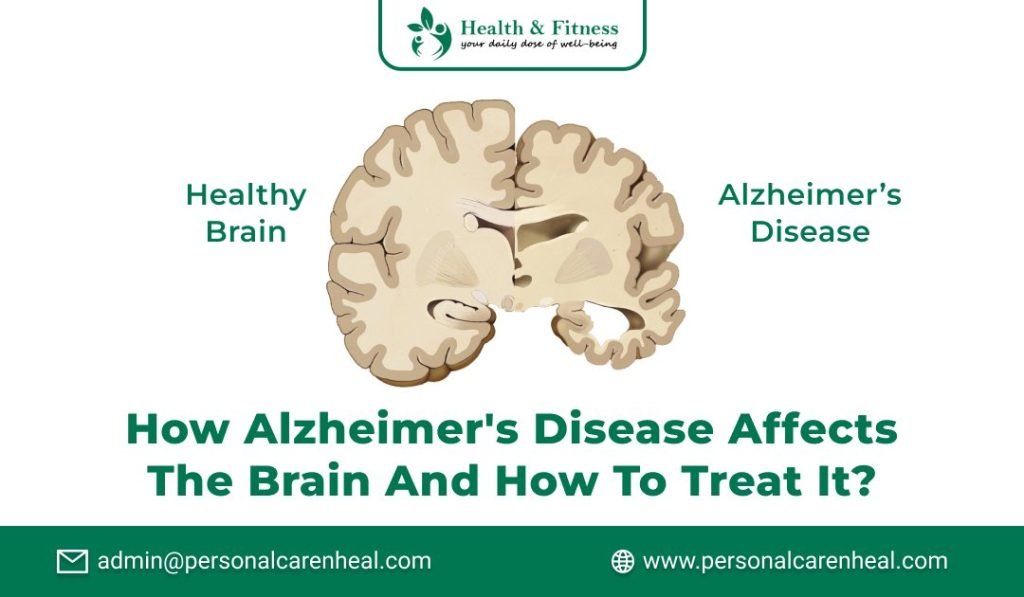 How Alzheimer's Disease Affects the Brain and How to Treat It?